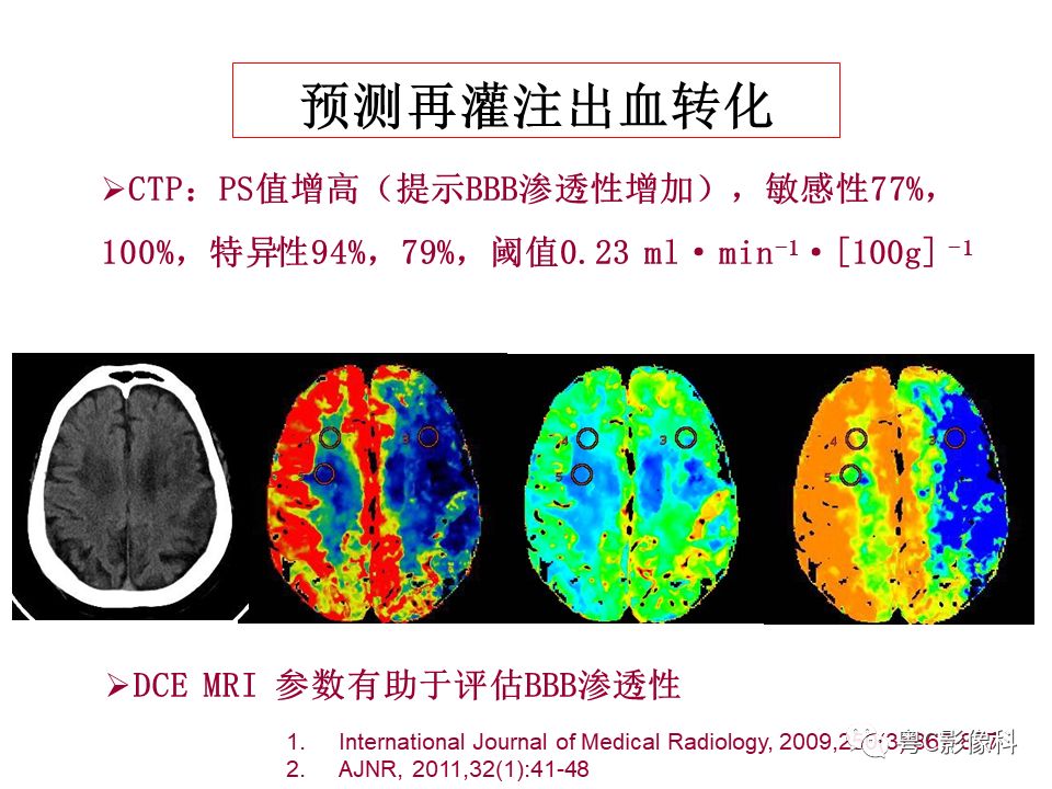 影像PPT - 【PPT】急性脑卒中影像学评估中容易被忽略的征象-19