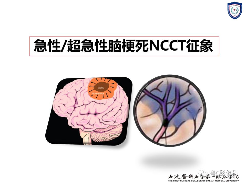 影像PPT - 【PPT】急性脑卒中影像学评估中容易被忽略的征象-20