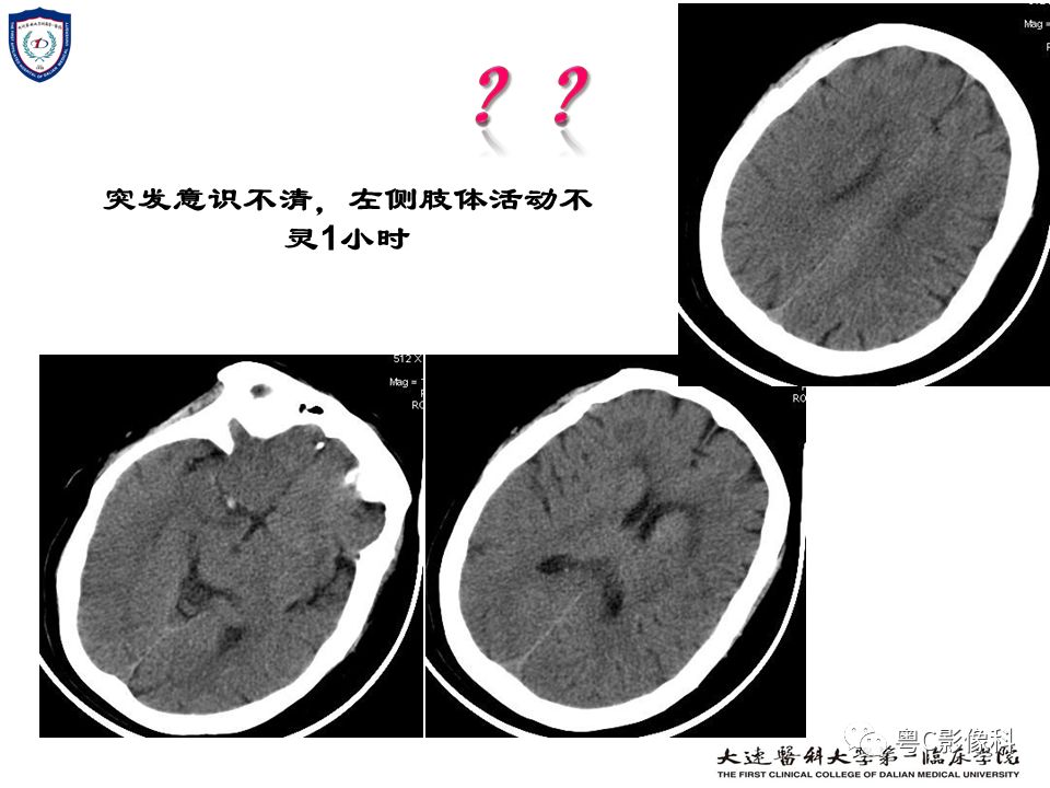 影像PPT - 【PPT】急性脑卒中影像学评估中容易被忽略的征象-24