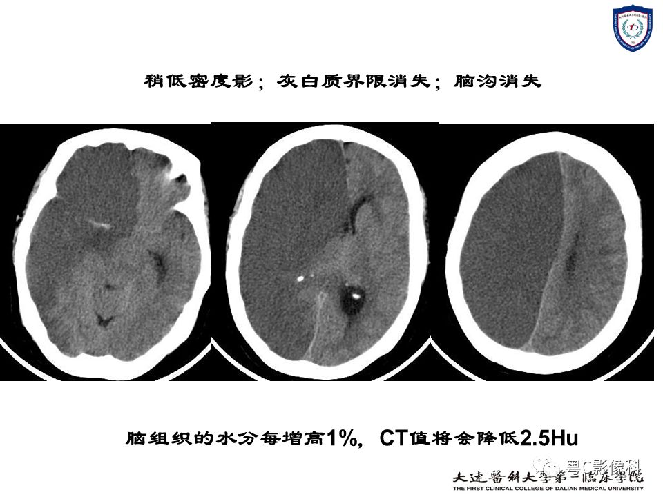 影像PPT - 【PPT】急性脑卒中影像学评估中容易被忽略的征象-25