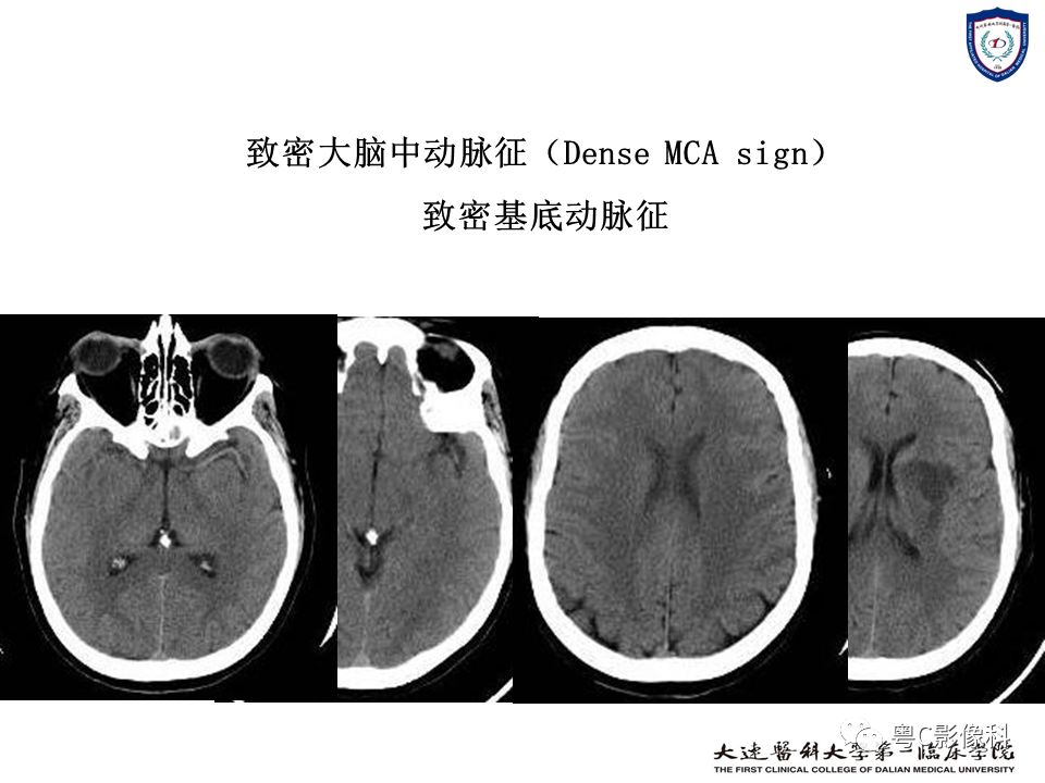 影像PPT - 【PPT】急性脑卒中影像学评估中容易被忽略的征象-27