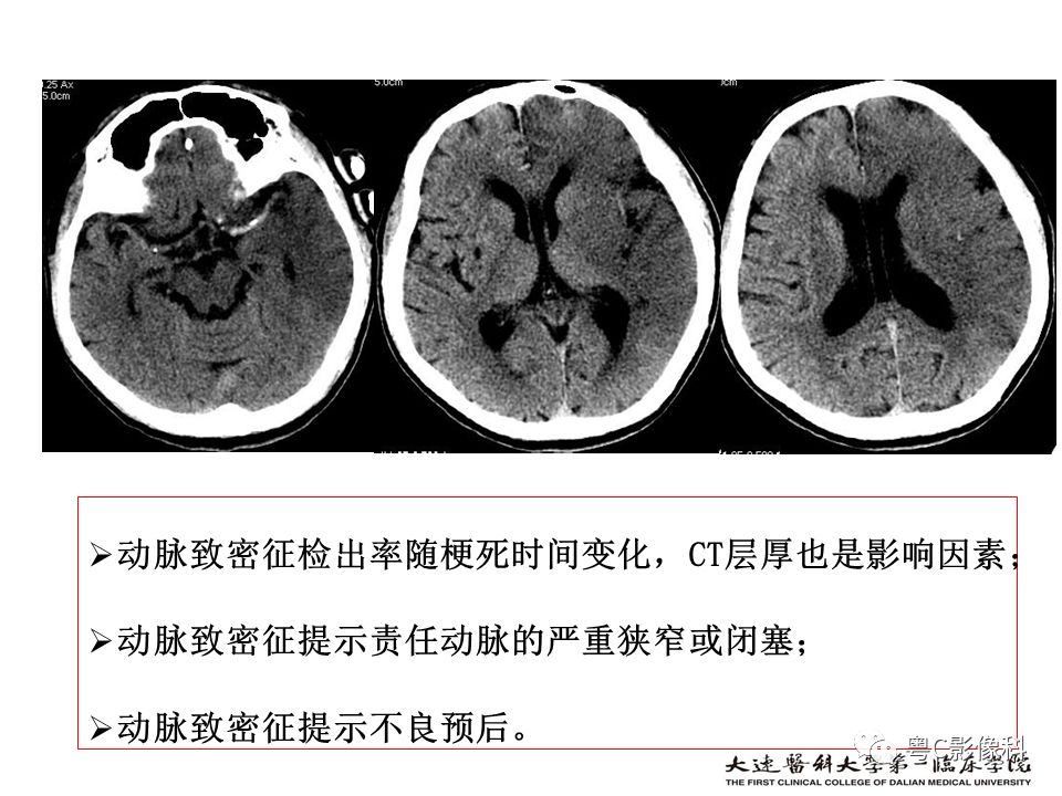 影像PPT - 【PPT】急性脑卒中影像学评估中容易被忽略的征象-28