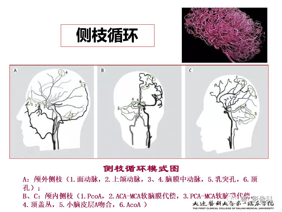 影像PPT - 【PPT】急性脑卒中影像学评估中容易被忽略的征象-29