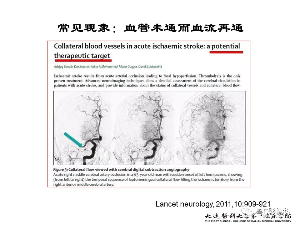 影像PPT - 【PPT】急性脑卒中影像学评估中容易被忽略的征象-30