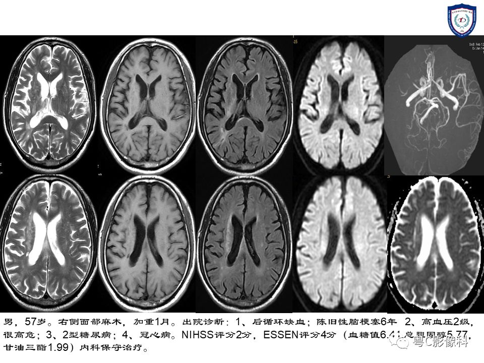 影像PPT - 【PPT】急性脑卒中影像学评估中容易被忽略的征象-38