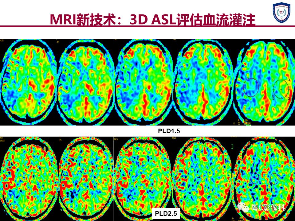 影像PPT - 【PPT】急性脑卒中影像学评估中容易被忽略的征象-39