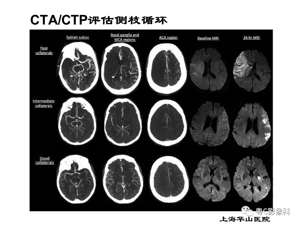影像PPT - 【PPT】急性脑卒中影像学评估中容易被忽略的征象-40