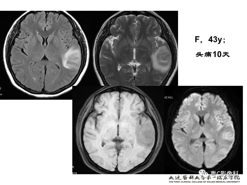 影像PPT - 【PPT】急性脑卒中影像学评估中容易被忽略的征象-41