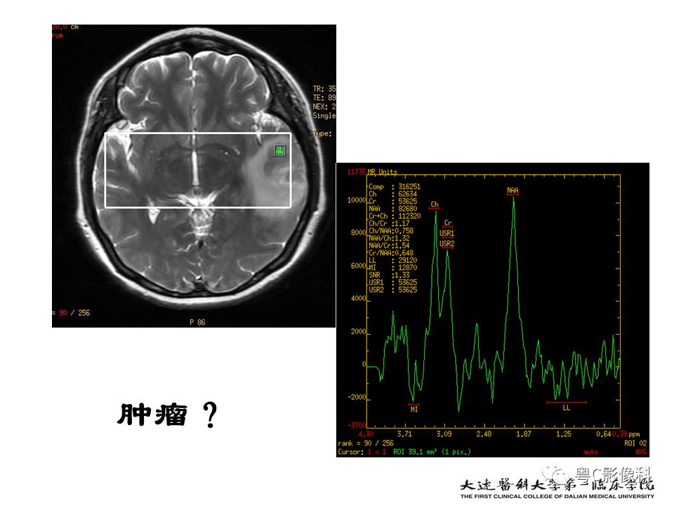 影像PPT - 【PPT】急性脑卒中影像学评估中容易被忽略的征象-42