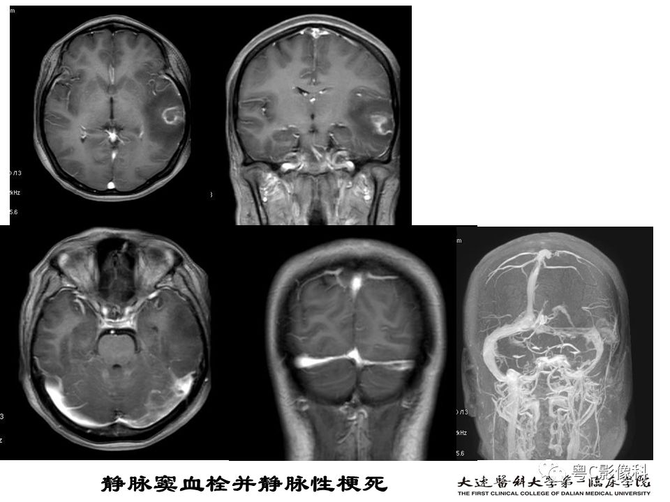 影像PPT - 【PPT】急性脑卒中影像学评估中容易被忽略的征象-44