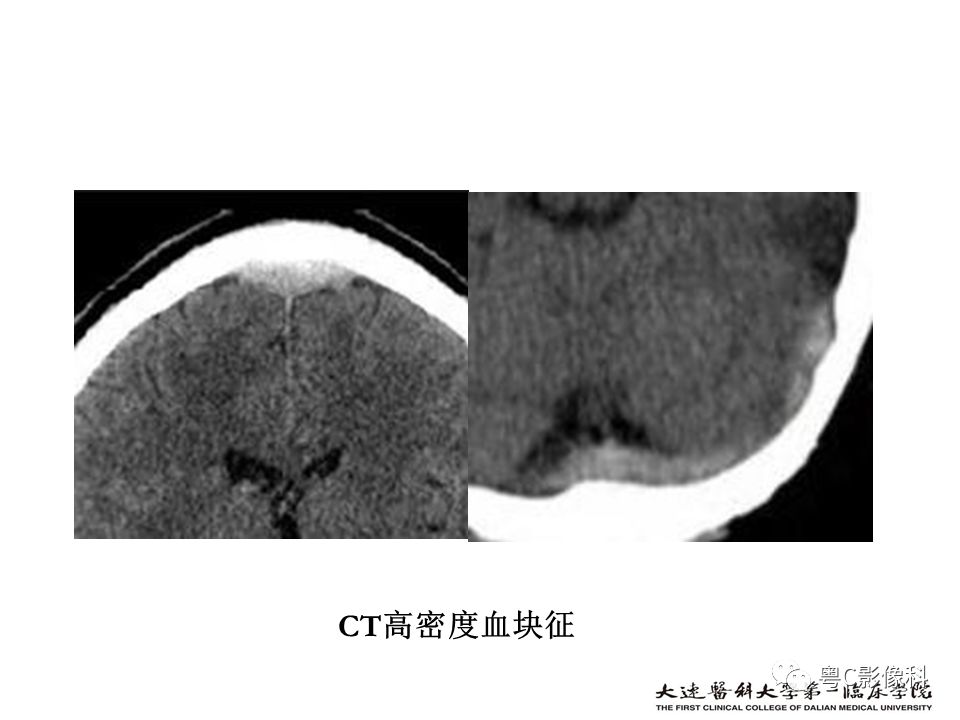 影像PPT - 【PPT】急性脑卒中影像学评估中容易被忽略的征象-48