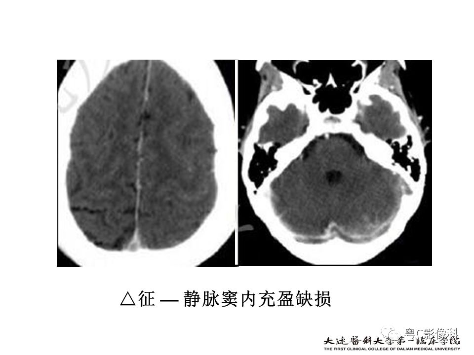 影像PPT - 【PPT】急性脑卒中影像学评估中容易被忽略的征象-49