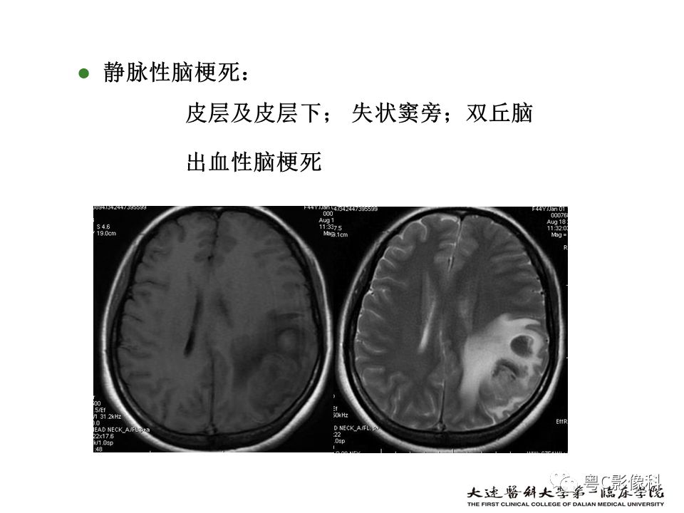 影像PPT - 【PPT】急性脑卒中影像学评估中容易被忽略的征象-51