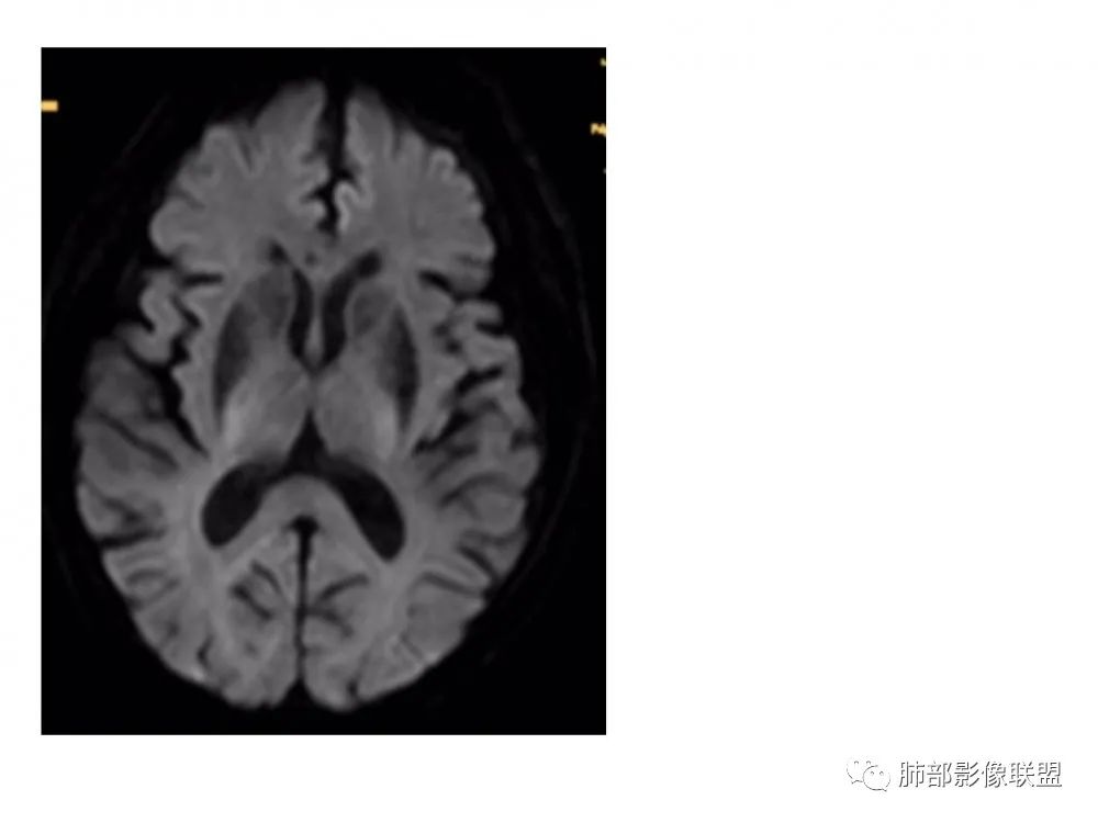 影像PPT - 【PPT】糖尿病非酮症偏侧舞蹈症-6