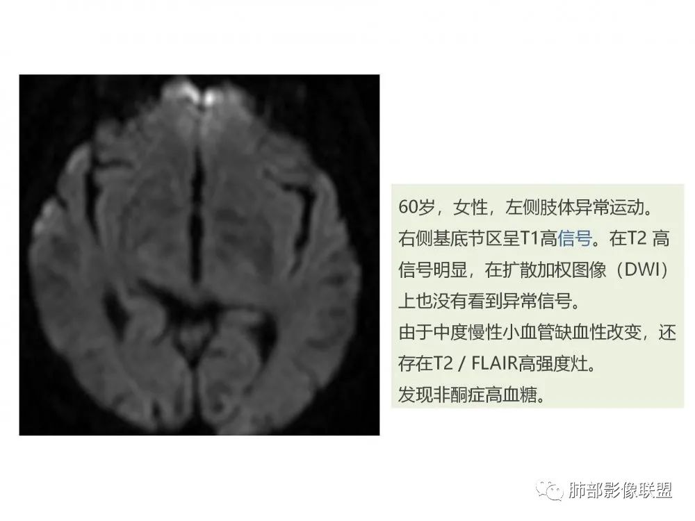 影像PPT - 【PPT】糖尿病非酮症偏侧舞蹈症-11