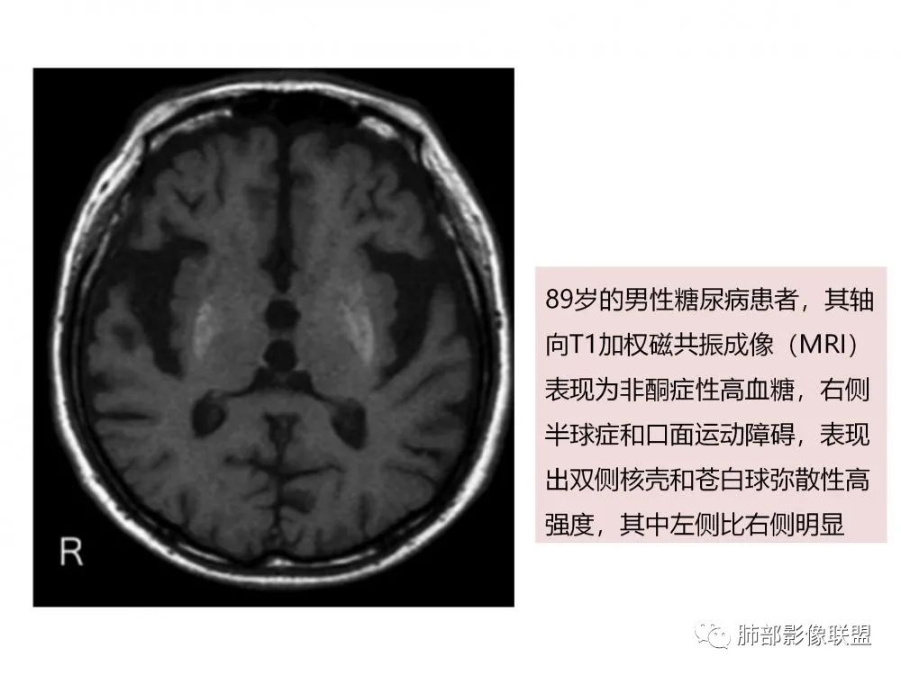 影像PPT - 【PPT】糖尿病非酮症偏侧舞蹈症-13