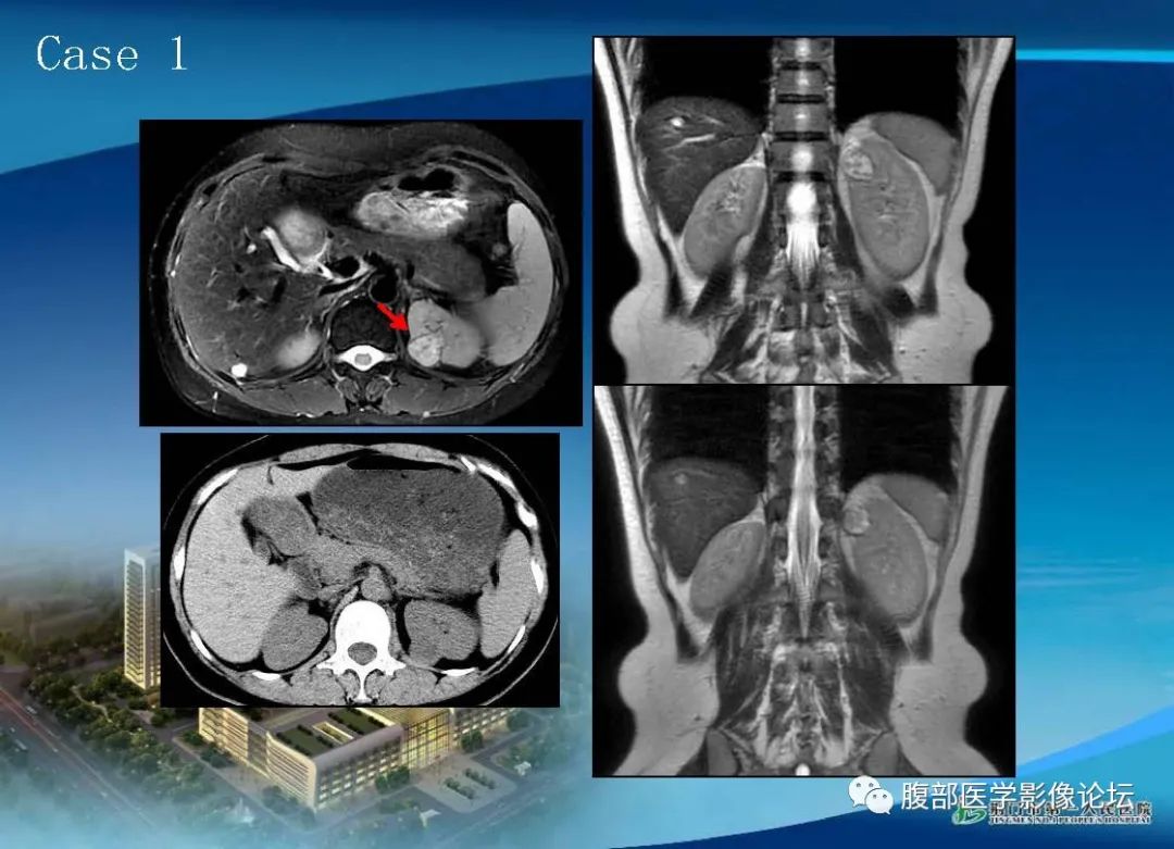 影像PPT - 【病例】肾细胞癌与肾血管平滑肌脂肪瘤AML CT鉴别诊断-2