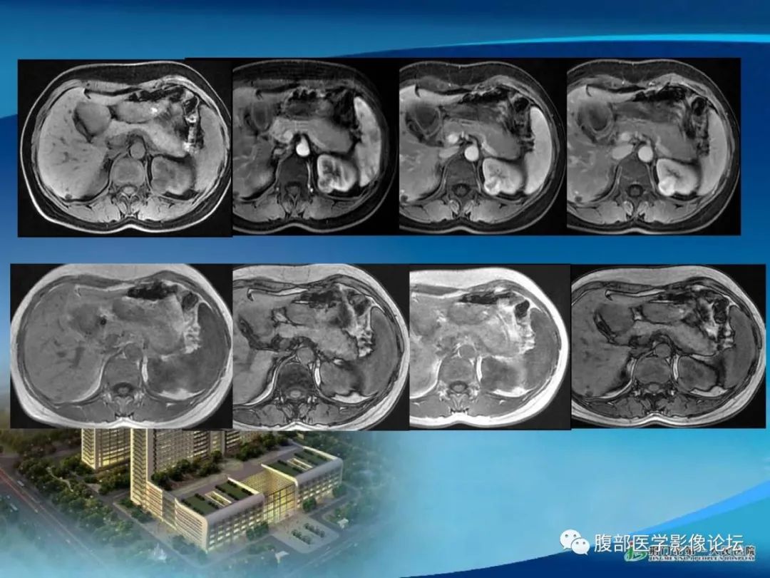 影像PPT - 【病例】肾细胞癌与肾血管平滑肌脂肪瘤AML CT鉴别诊断-3