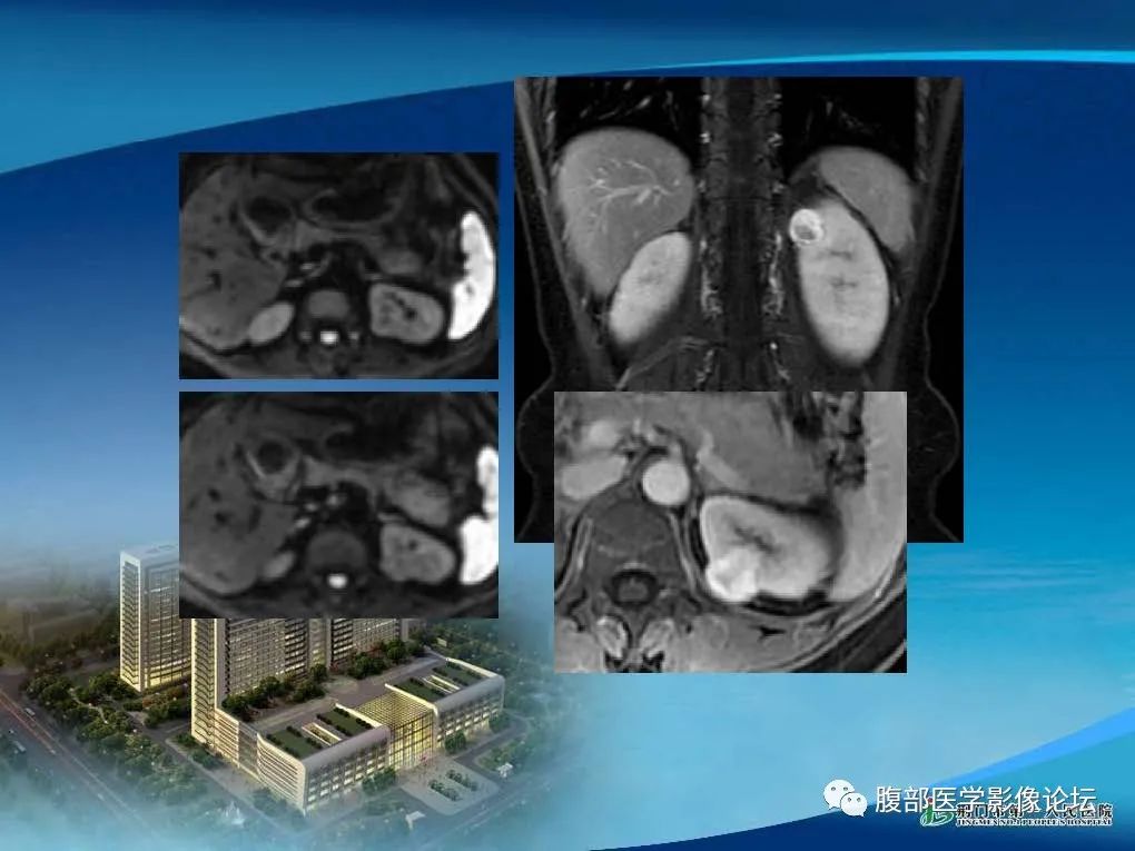 影像PPT - 【病例】肾细胞癌与肾血管平滑肌脂肪瘤AML CT鉴别诊断-4