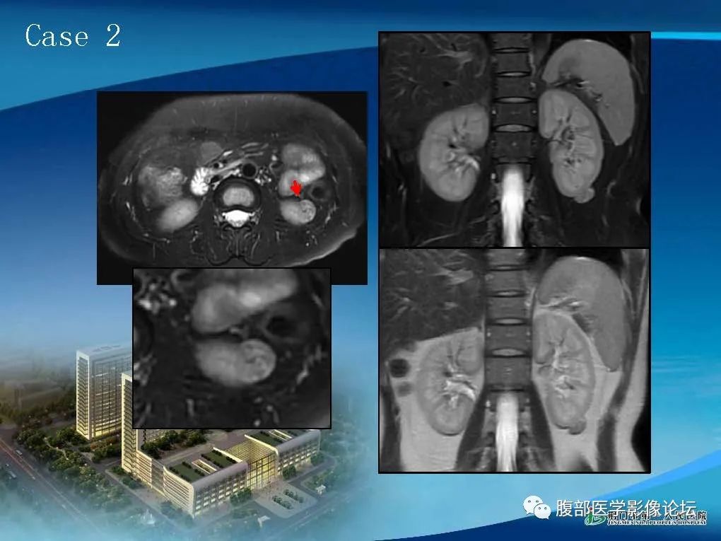 影像PPT - 【病例】肾细胞癌与肾血管平滑肌脂肪瘤AML CT鉴别诊断-5