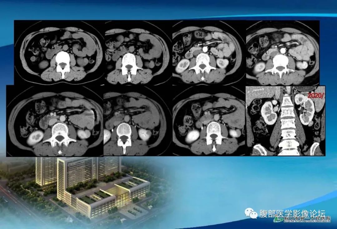 影像PPT - 【病例】肾细胞癌与肾血管平滑肌脂肪瘤AML CT鉴别诊断-7