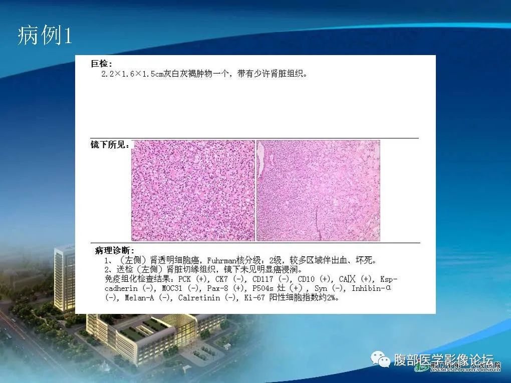 影像PPT - 【病例】肾细胞癌与肾血管平滑肌脂肪瘤AML CT鉴别诊断-9