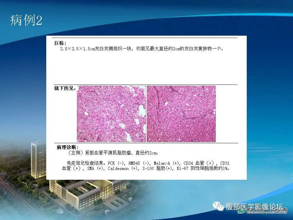 影像PPT - 【病例】肾细胞癌与肾血管平滑肌脂肪瘤AML CT鉴别诊断-10