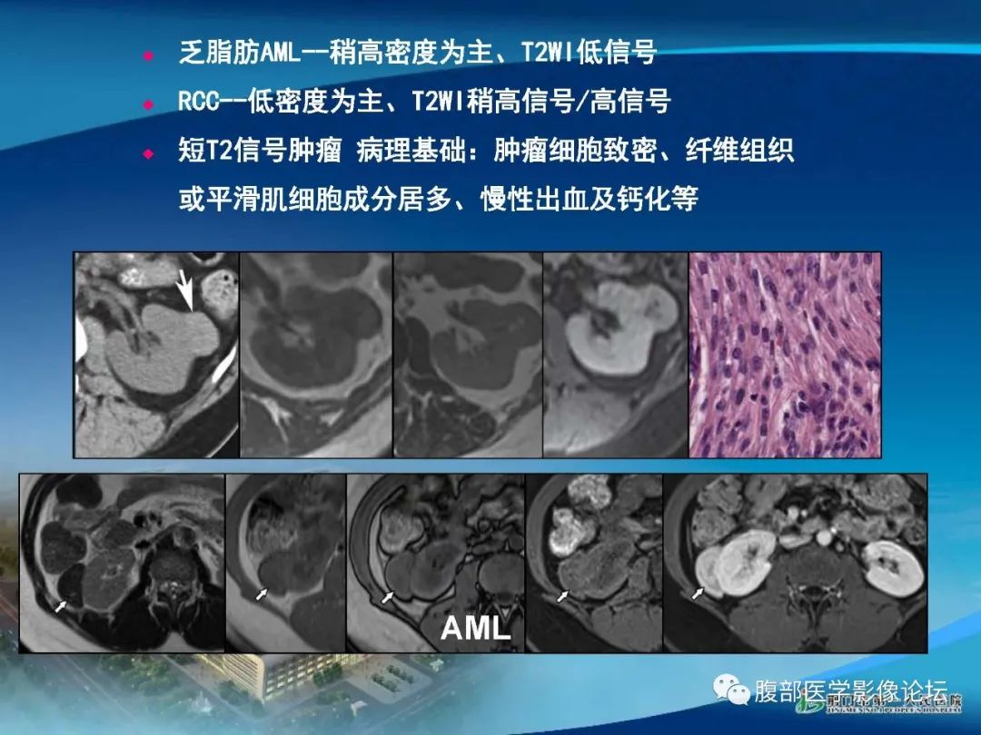影像PPT - 【病例】肾细胞癌与肾血管平滑肌脂肪瘤AML CT鉴别诊断-16