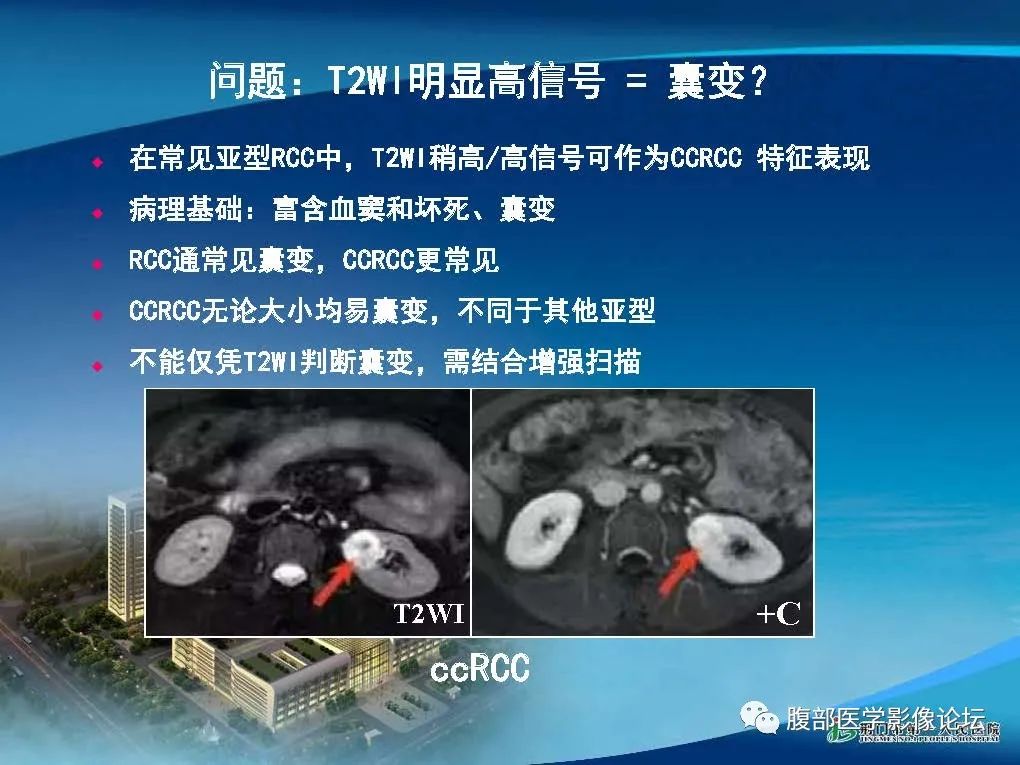 影像PPT - 【病例】肾细胞癌与肾血管平滑肌脂肪瘤AML CT鉴别诊断-17