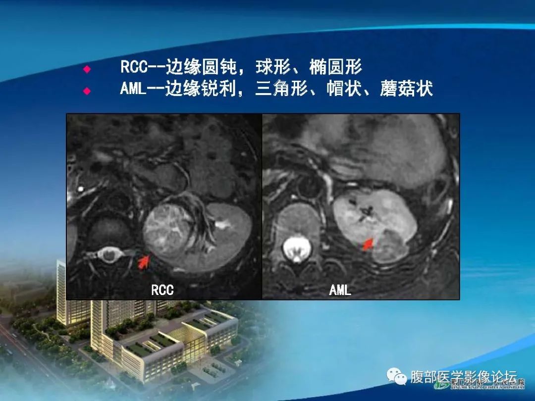 影像PPT - 【病例】肾细胞癌与肾血管平滑肌脂肪瘤AML CT鉴别诊断-18