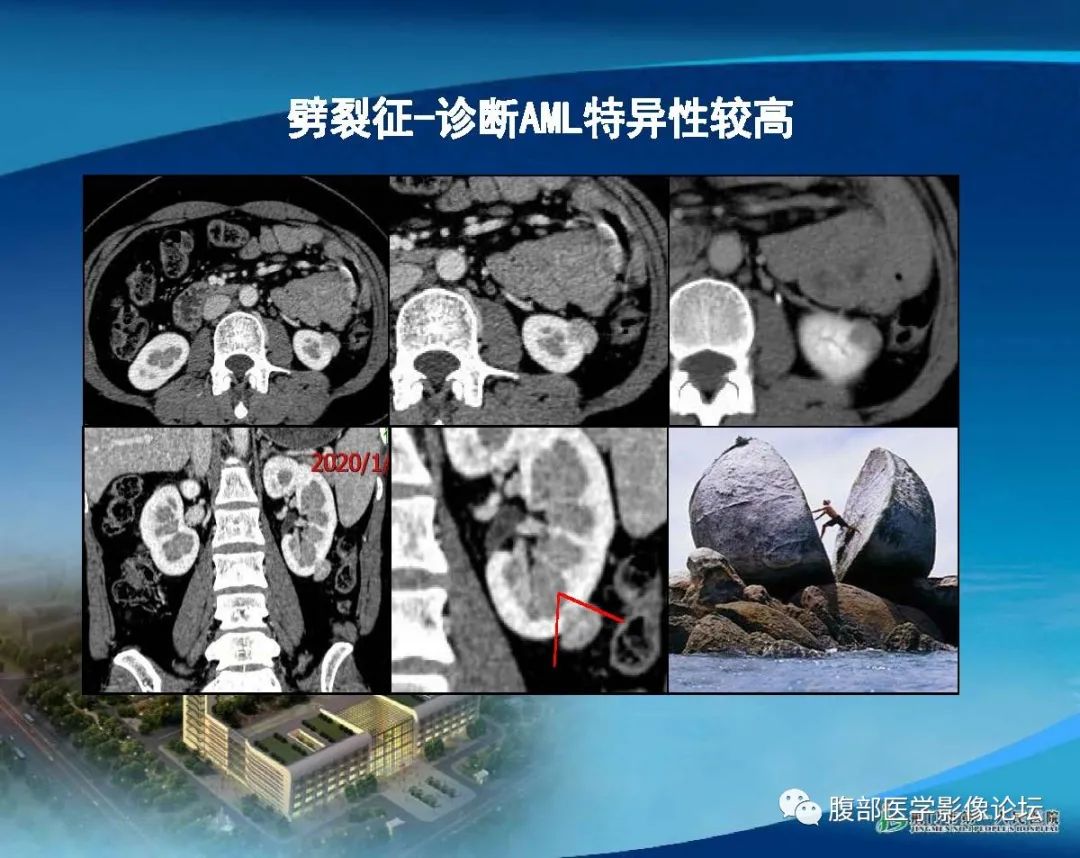 影像PPT - 【病例】肾细胞癌与肾血管平滑肌脂肪瘤AML CT鉴别诊断-19