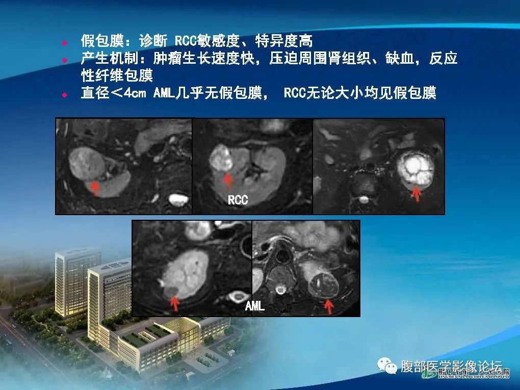 影像PPT - 【病例】肾细胞癌与肾血管平滑肌脂肪瘤AML CT鉴别诊断-20