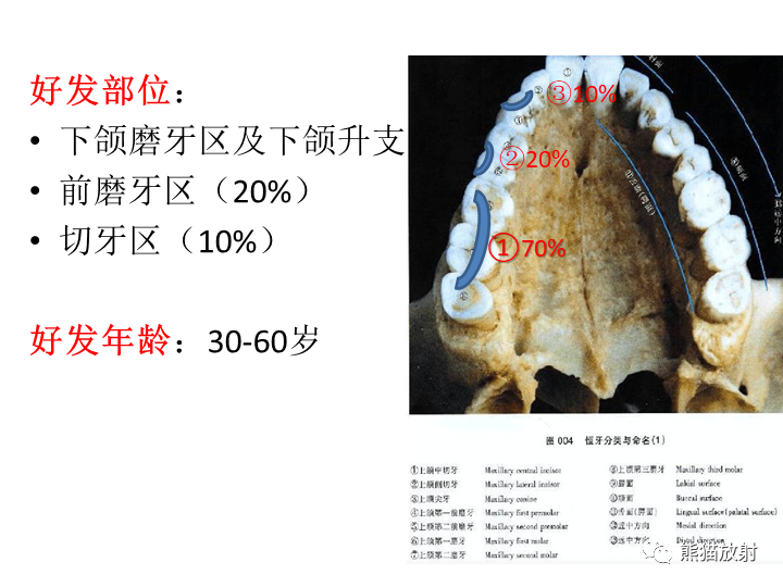 影像PPT - 【病例】颌骨造釉细胞瘤/成釉细胞瘤2例CT影像-19