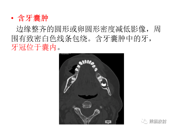 影像PPT - 【病例】颌骨造釉细胞瘤/成釉细胞瘤2例CT影像-26