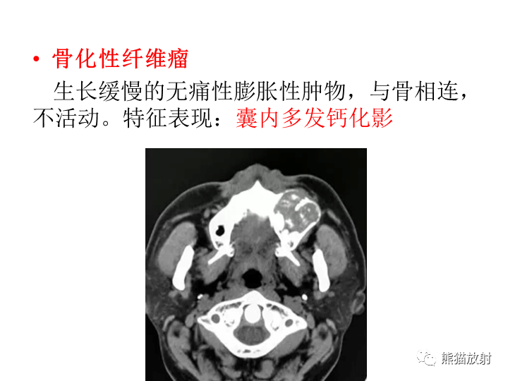 影像PPT - 【病例】颌骨造釉细胞瘤/成釉细胞瘤2例CT影像-27