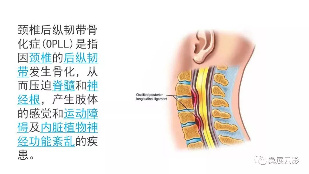 影像PPT - 【PPT】颈椎后纵韧带骨化症（OPLL）X线诊断-2
