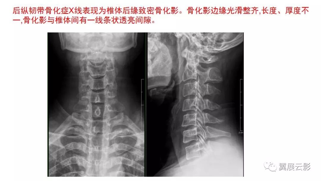 影像PPT - 【PPT】颈椎后纵韧带骨化症（OPLL）X线诊断-10