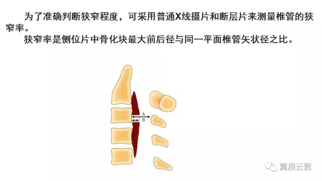 影像PPT - 【PPT】颈椎后纵韧带骨化症（OPLL）X线诊断-13