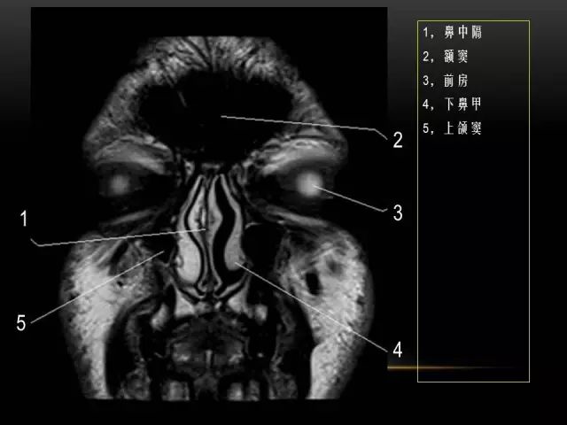 影像PPT - MRI下的眼部及鼻窦解剖-4