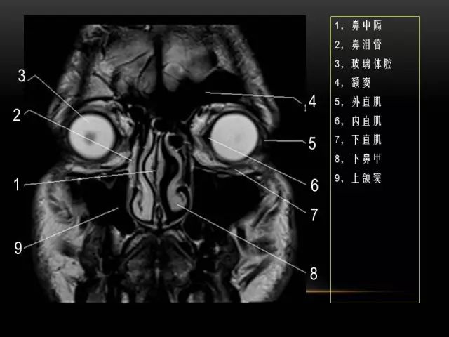 影像PPT - MRI下的眼部及鼻窦解剖-6