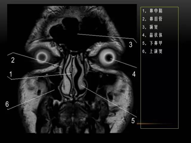 影像PPT - MRI下的眼部及鼻窦解剖-5