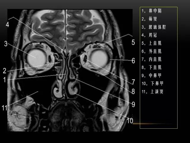 影像PPT - MRI下的眼部及鼻窦解剖-9