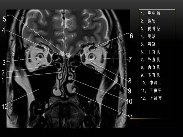 影像PPT - MRI下的眼部及鼻窦解剖-11