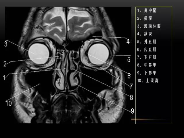 影像PPT - MRI下的眼部及鼻窦解剖-7