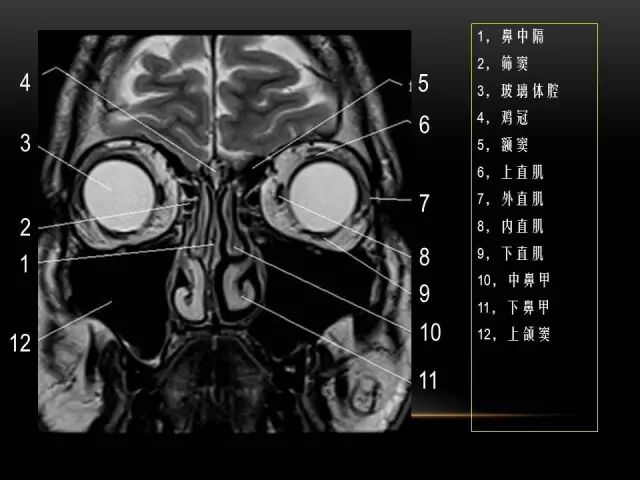 影像PPT - MRI下的眼部及鼻窦解剖-8