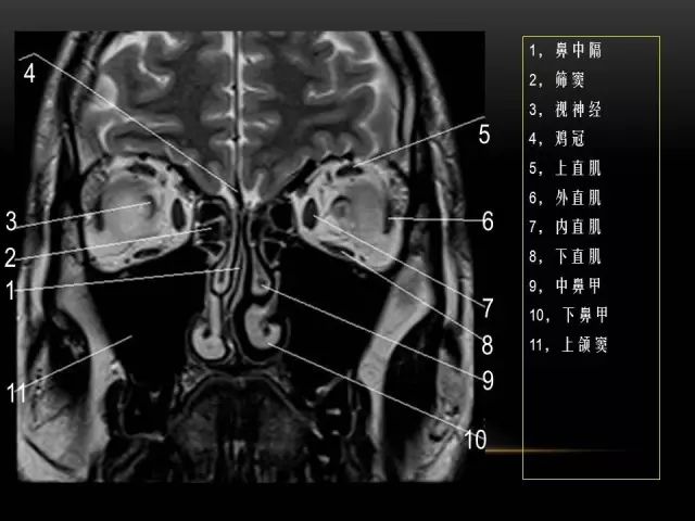 影像PPT - MRI下的眼部及鼻窦解剖-10
