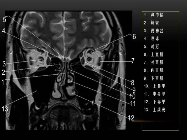 影像PPT - MRI下的眼部及鼻窦解剖-12