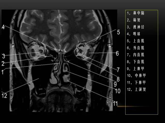 影像PPT - MRI下的眼部及鼻窦解剖-13