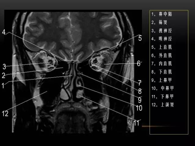 影像PPT - MRI下的眼部及鼻窦解剖-14