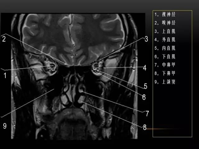 影像PPT - MRI下的眼部及鼻窦解剖-15